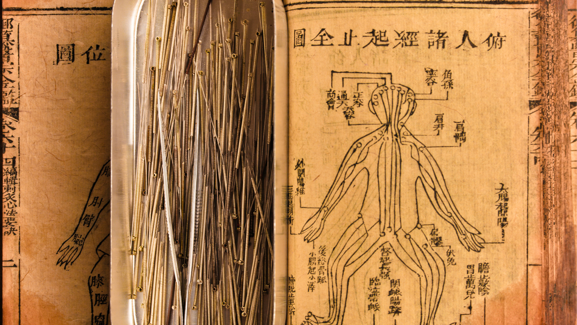 NUENCE MTC ET L'ACUPUNCTURE